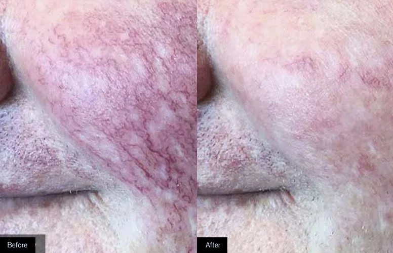 Broken Blood Vessel Treatment — Ingleton Dermatology P.C.